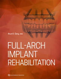 Full-Arch Implant Rehabilitation