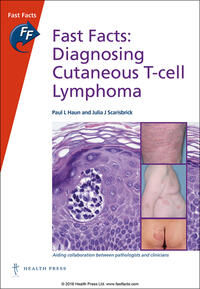 Fast Facts: Diagnosing Cutaneous T-Cell Lymphoma